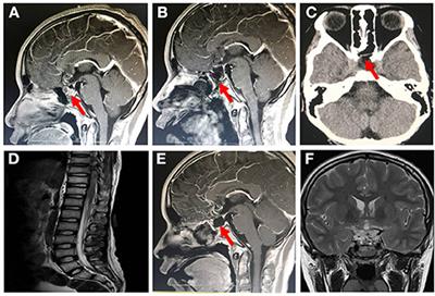 Successful Treatment With Intrathecal and Intravenous Polymyxin B-Based Combination Against MDR Acinetobacter baumannii Meningitis in Pediatric Patient: A Case Report